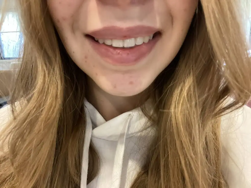 Albany Braces