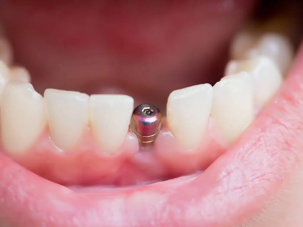 Pittsburgh Dental Implants and Periodontics