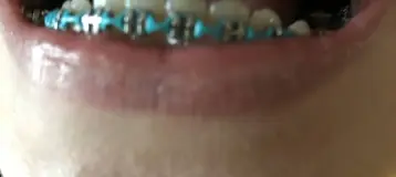 Albany Braces