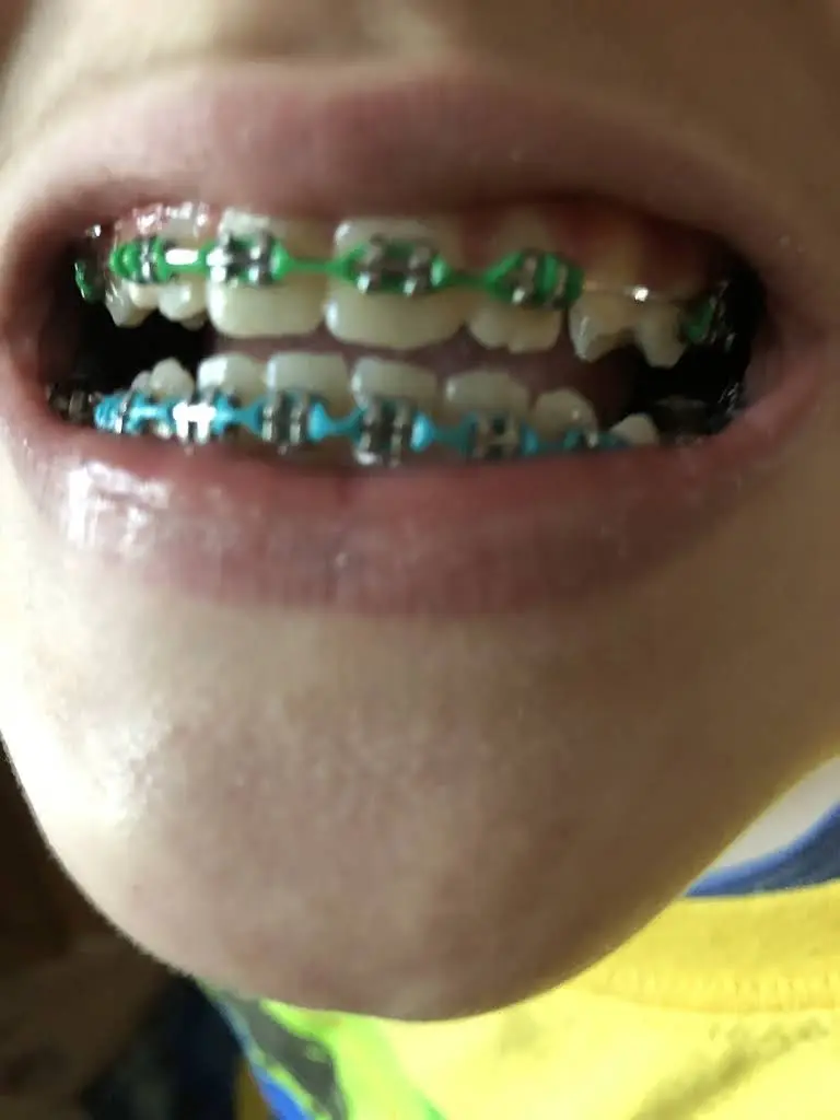 Albany Braces