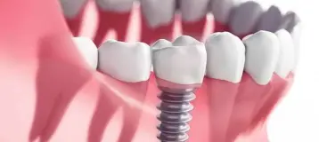 Albany Implant Clinic