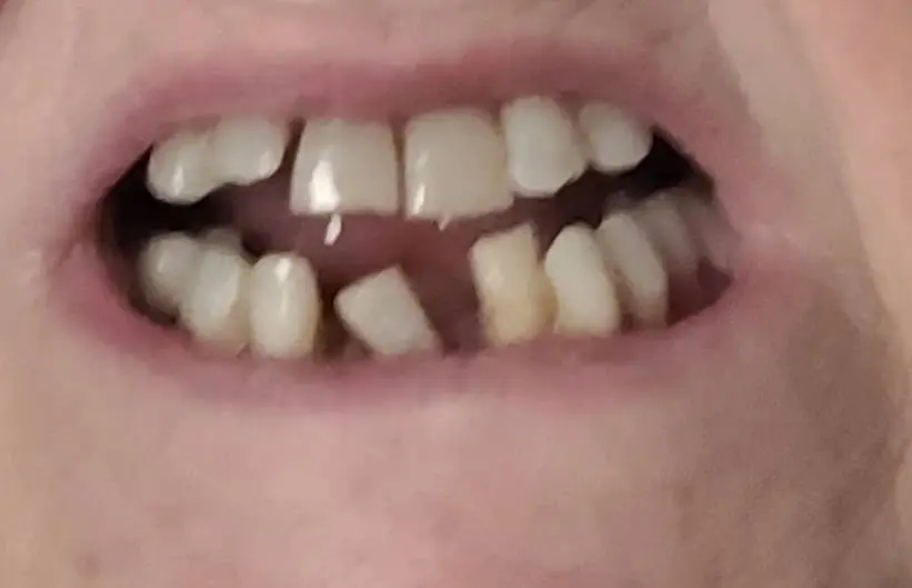 Affordable Dentures & Implants