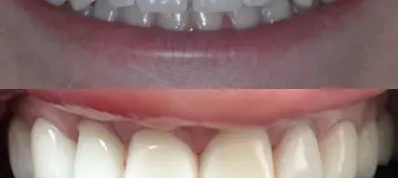 Veneer Smiles