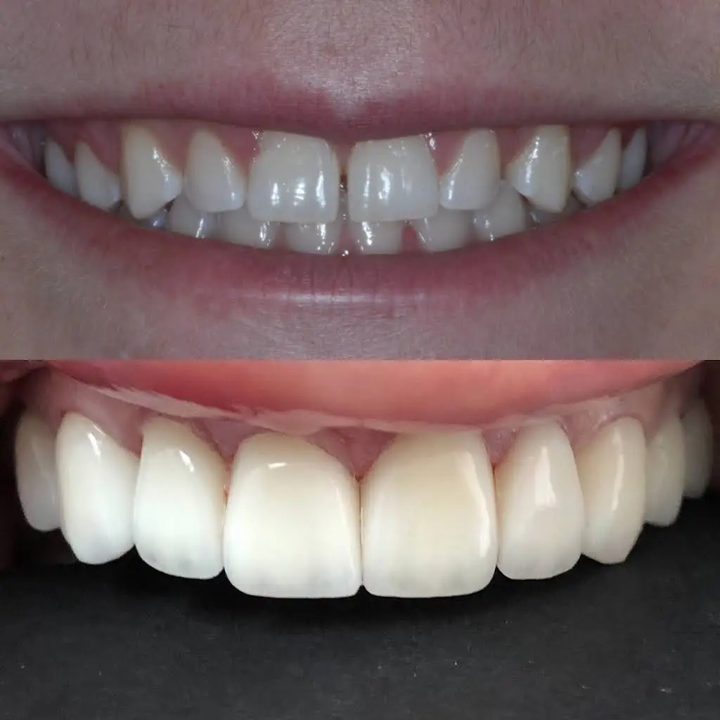 Veneer Smiles