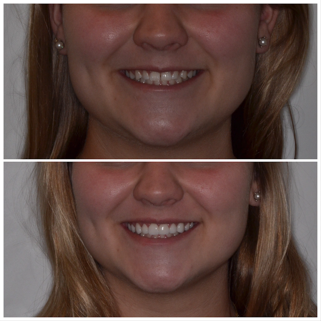 Veneer Smiles