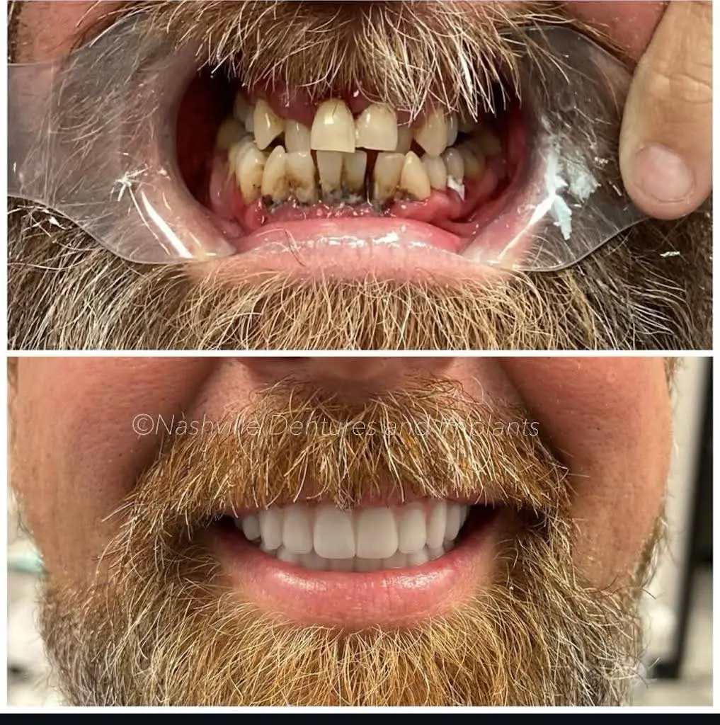 Georgia Implants and Dentures