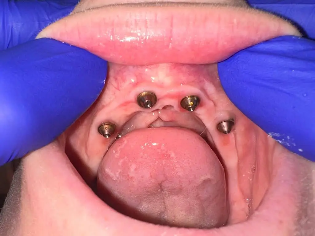 Georgia Implants and Dentures