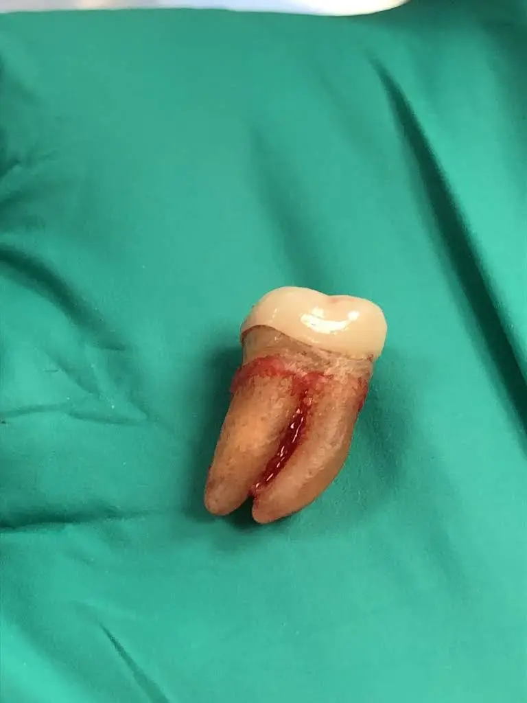 Affordable Dentures & Implants
