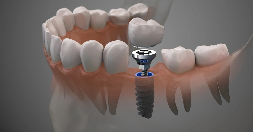 Boca Dental and Braces