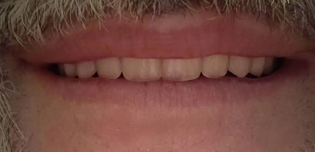 Affordable Dentures & Implants