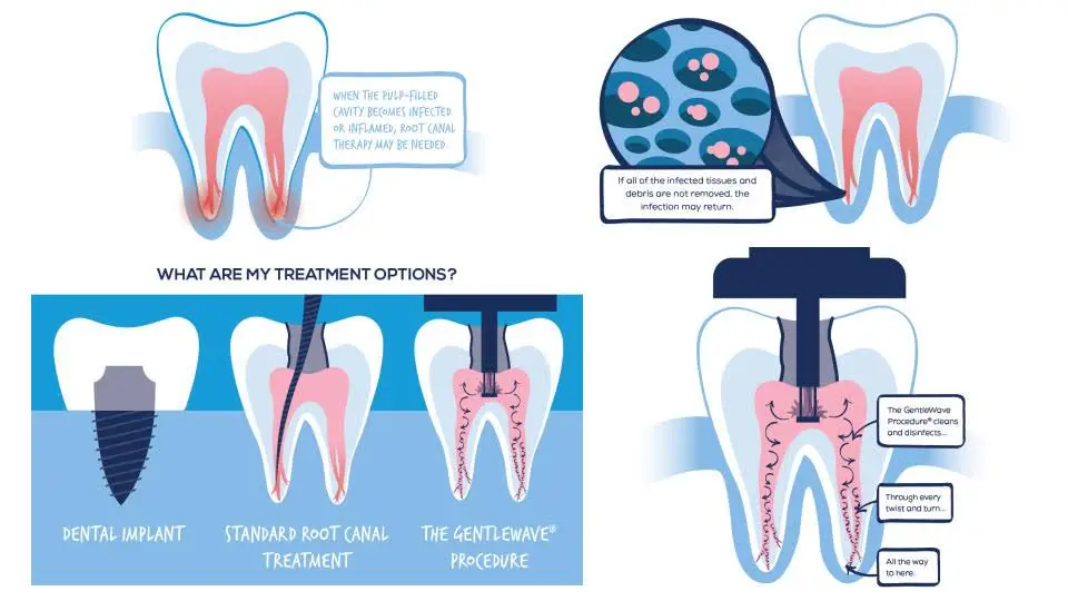 Elevate Endodontics