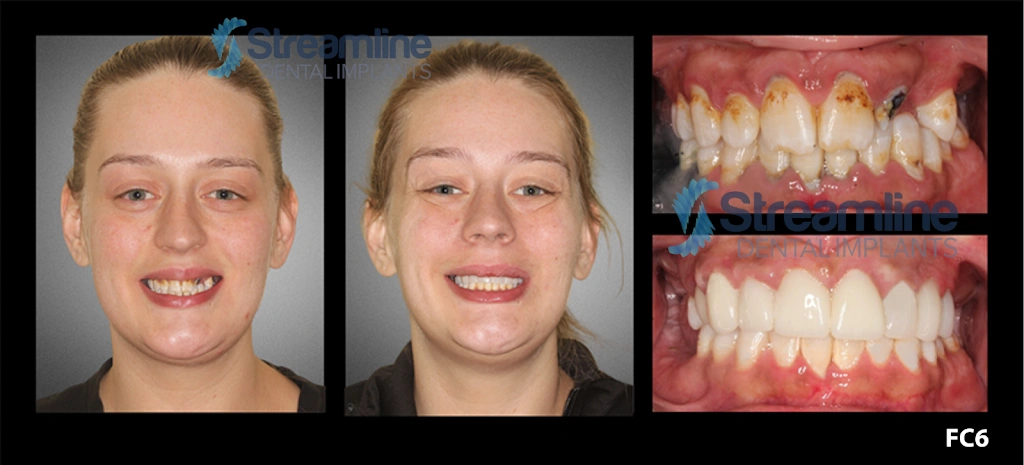 Streamline Dental Implants