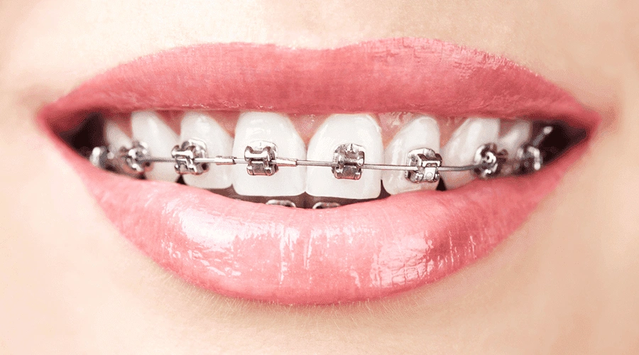 Braces Las Vegas