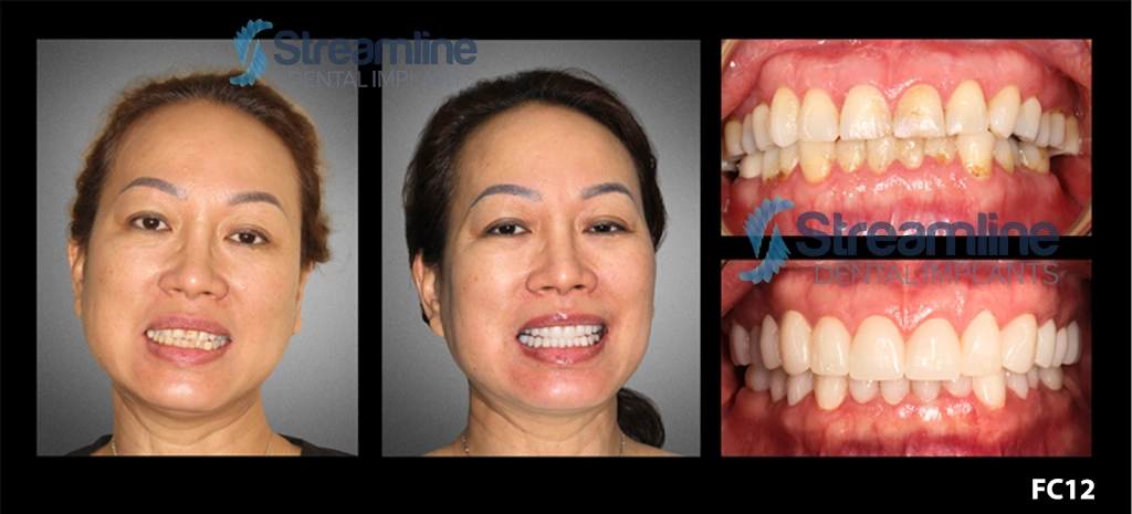 Braces Las Vegas