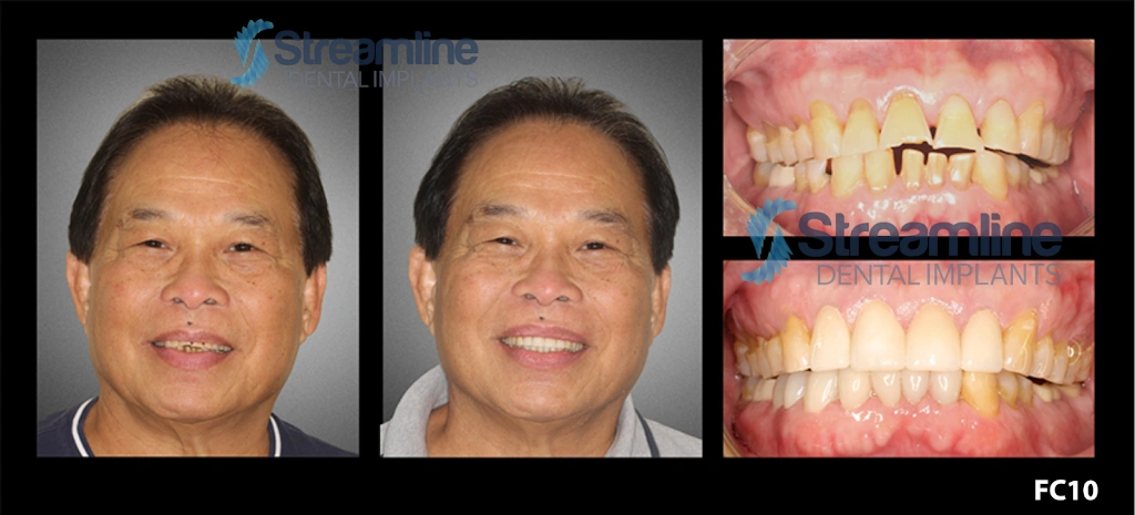 Braces Las Vegas