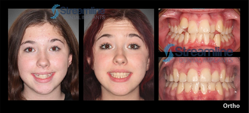 Braces Las Vegas