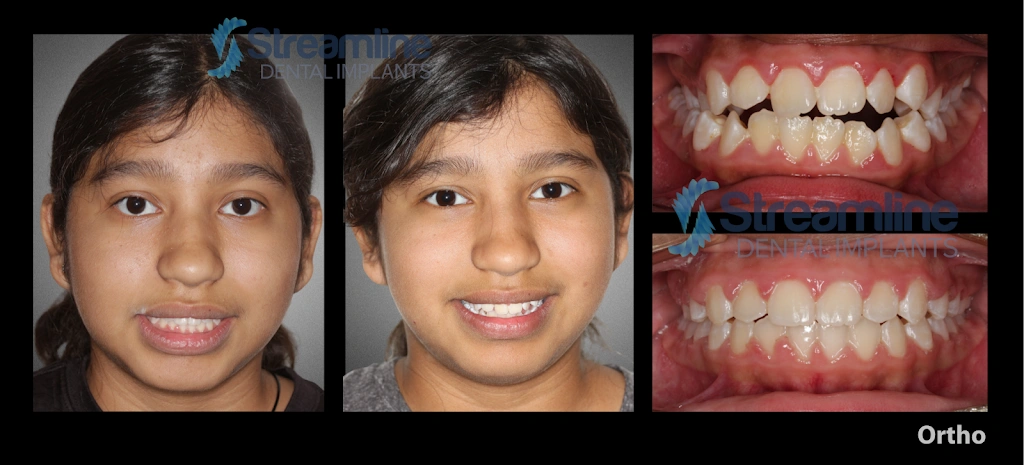 Braces Las Vegas