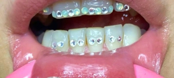 IceBurgh Teeth Gems