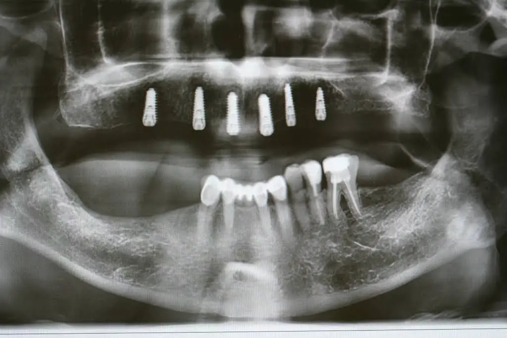 The Center for Dental Implants