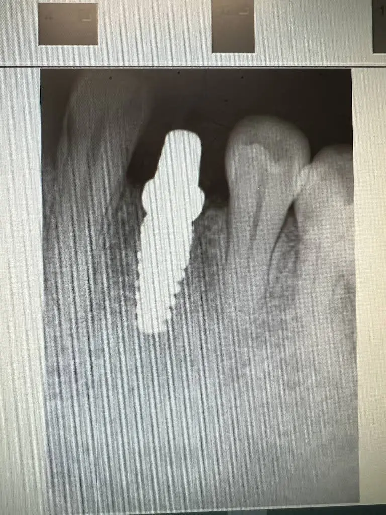 ImplantWIDE