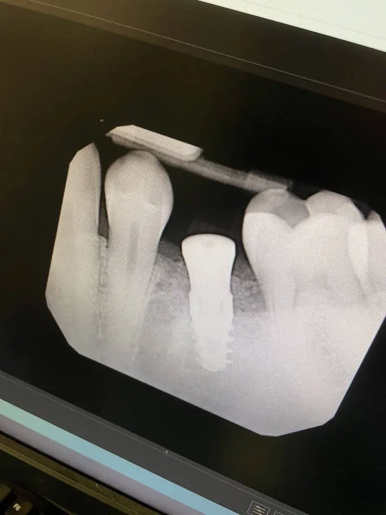 ImplantWIDE
