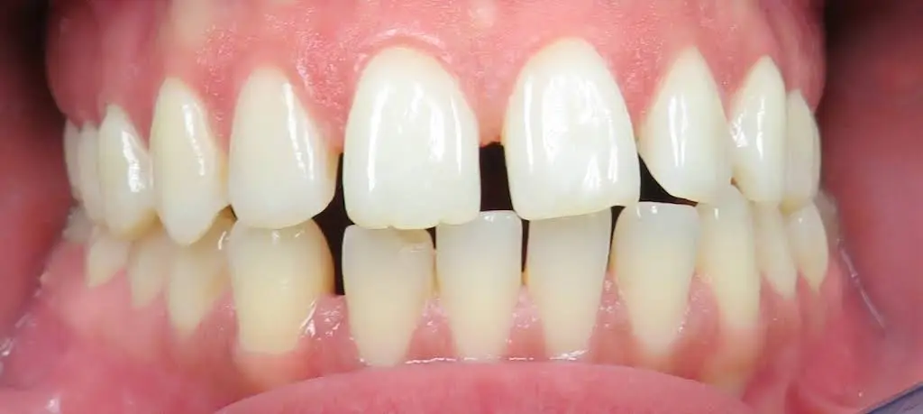 Blooming Braces