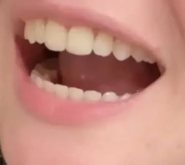 Blooming Braces