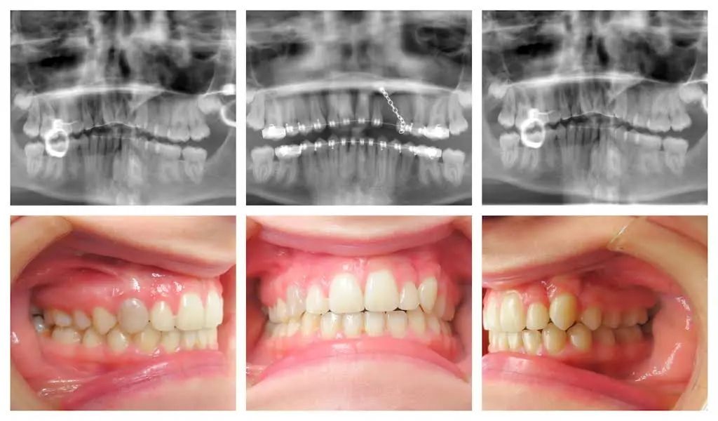 Blooming Braces