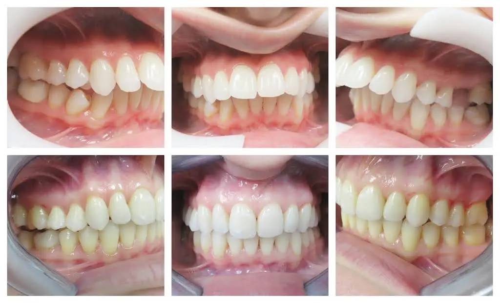 Blooming Braces