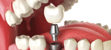 Now Dentures and Implants