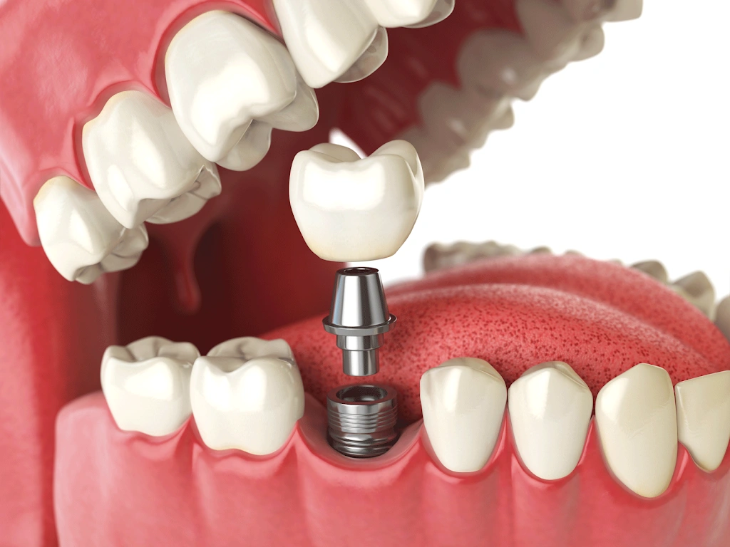 Now Dentures and Implants