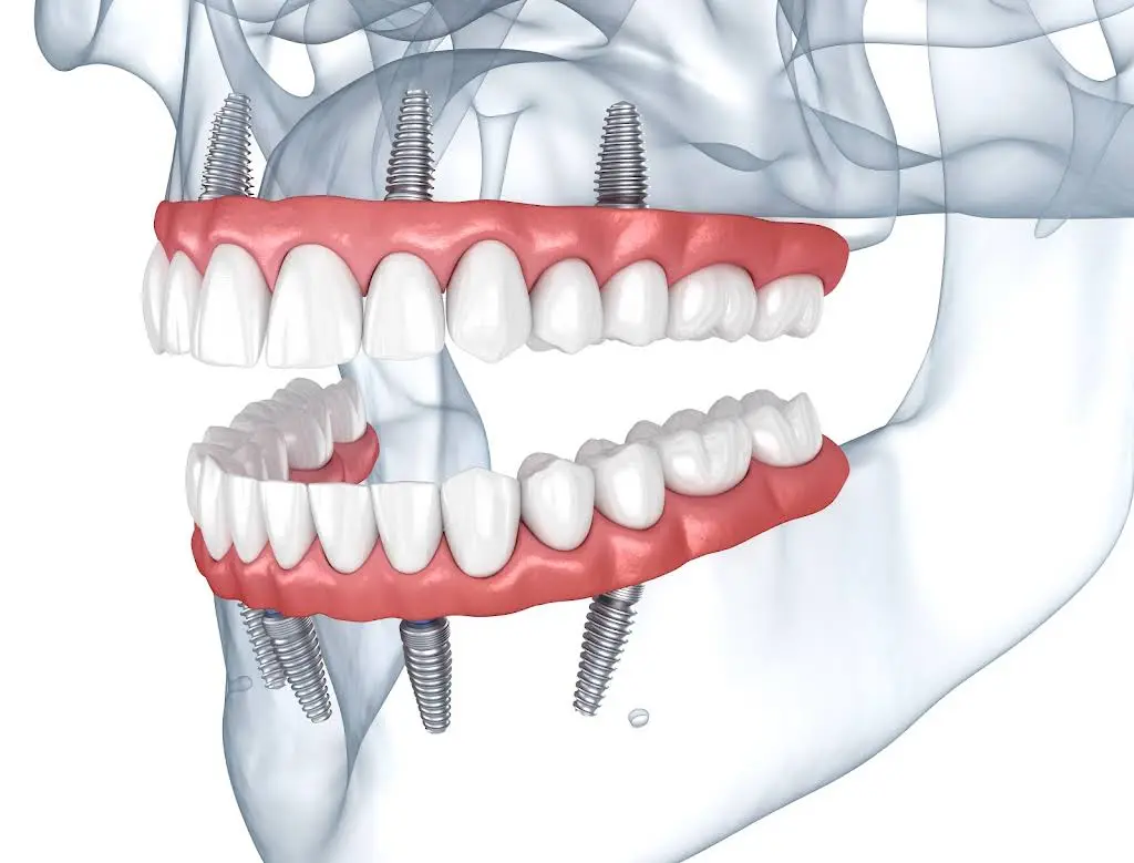 Now Dentures and Implants