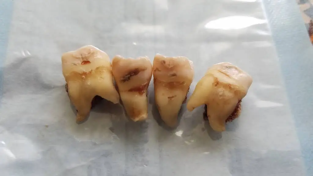Wisdom Teeth Guys