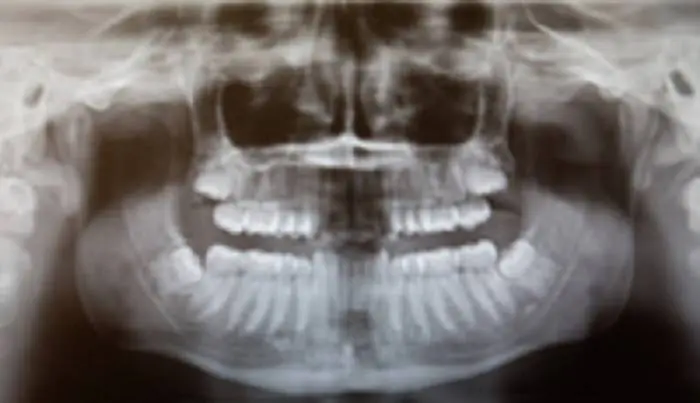 ChewsWisely Dental Implant Center