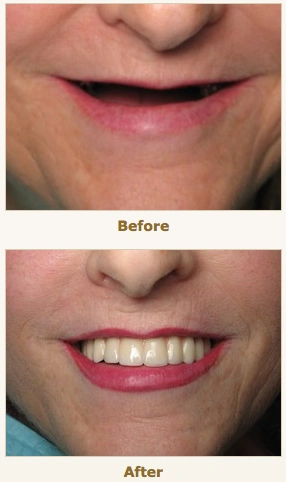 ChewsWisely Dental Implant Center