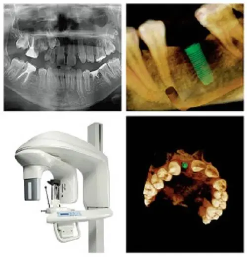 ChewsWisely Dental Implant Center