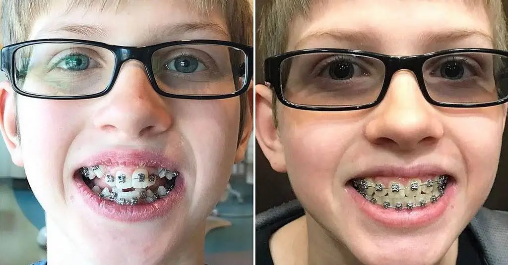 Las Vegas Braces