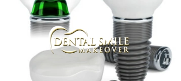 Dental Smile Makeover