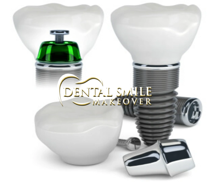 Dental Smile Makeover
