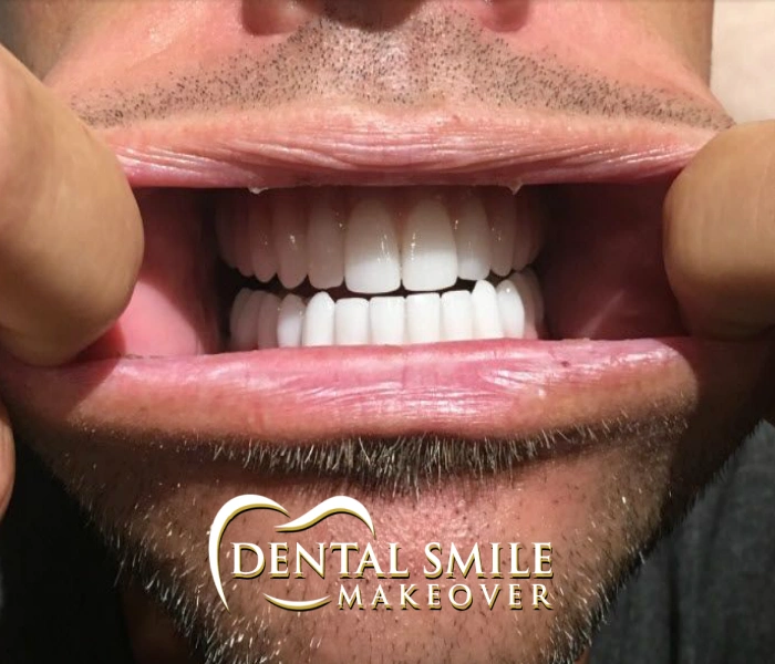 Dental Smile Makeover