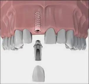 Anthem Periodontics and Dental Implants