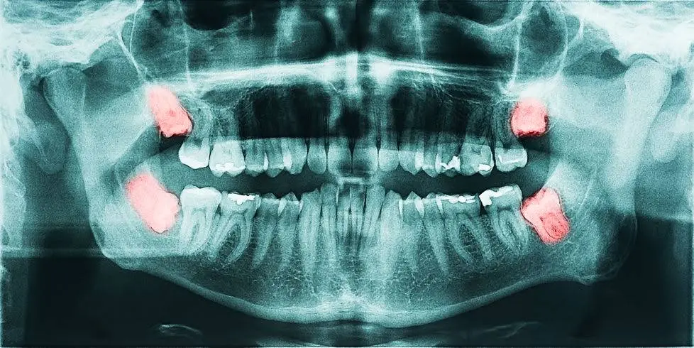 Precision Oral Surgery and Implants