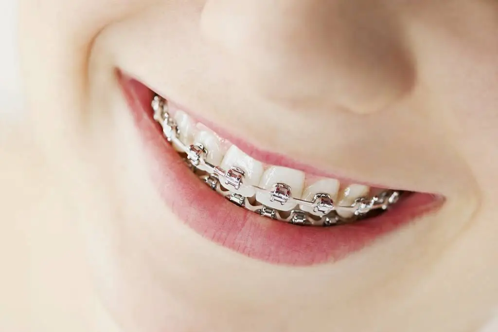 Cool Braces: Dr. Ejaz Tahir, DDS, MS