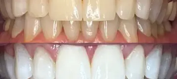 We Whiten Teeth Whitening