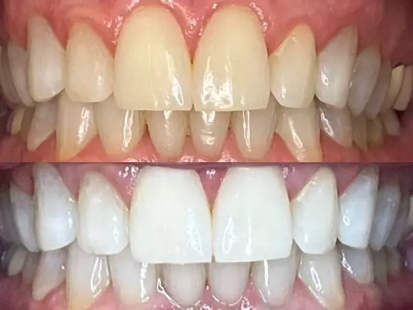 We Whiten Teeth Whitening