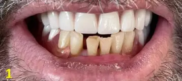 Affordable Dentures & Implants