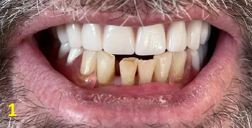 Affordable Dentures & Implants