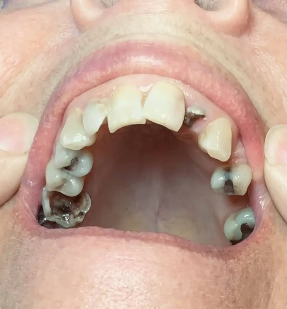 Affordable Dentures & Implants