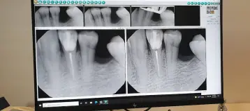 Illinois Valley Endodontics, Dr. Lee Ceresa D.D.S.