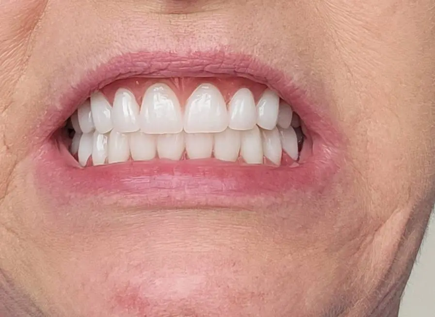 Allstar Implants Plus